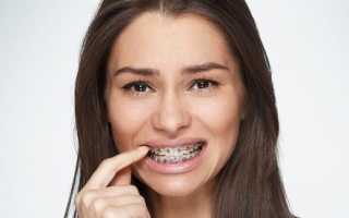 Почему шатаются зубы при коррекции дефектов прикуса брекетами и насколько это опасно?