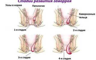 Воспаление геморроидальных узлов: симптомы и лечение