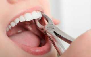 Что значит «простое удаление зуба», и как проводится процедура