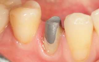О популярности металлических вкладок в зубы и их особенностях