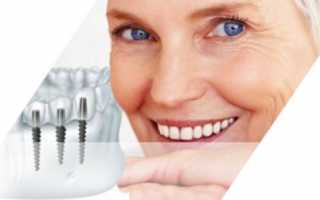 Почему эксперты склоняются к выбору двухэтапного метода имплантации зубов