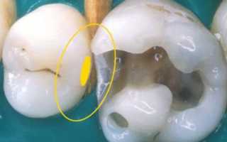Задачи, решаемые с помощью компомерных материалов в современной стоматологии