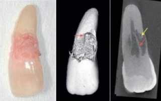 Чем опасна резорбция корней зубов, как ее лечат?