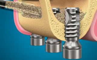Что такое синус-лифтинг в стоматологии? Для чего это нужно