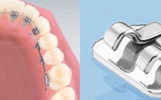 Невидимое и комфортное исправление дефектов брекетами Forestadent 2d