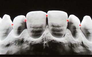 Что такое контактный пункт зуба и важность отсутствия нарушений
