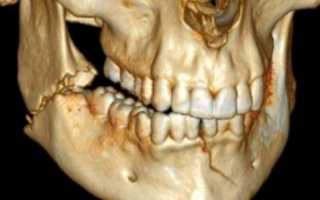 Факторы, влияющие на выбор тактики лечения перелома нижней челюсти
