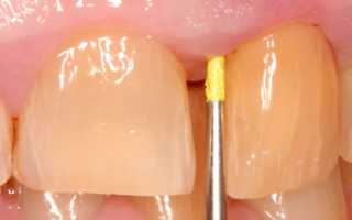 Воспаление надкостницы зуба: какое лечение назначит врач