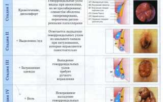 Может ли геморройное расширение вен пройти без лечения?