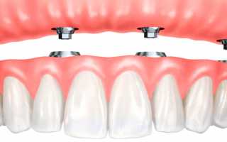 Какое протезирование зубов применяют при их полном отсутствии