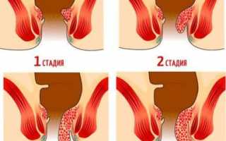 Лечение тяжелой 4 стадии геморроя