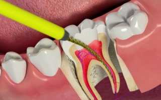 Что такое эндодонтическое лечение зубов и нюансы его проведения