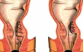 Подробное описание дезартеризации геморроидальных узлов