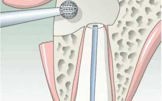 Особенности цистэктомии кисты зуба и возможные риски
