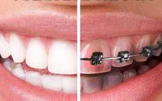 Обязательно ли нужно проводить отбеливание зубов после снятия брекетов