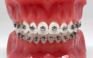 Насколько популярны среди пациентов ортодонтии брекеты Damon 3