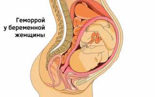 Геморрой после родов: специфика лечения