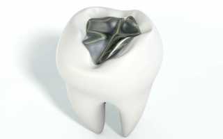 Закрытие полости зуба в стоматологии пломбой из амальгамы ― хорошо это или плохо?