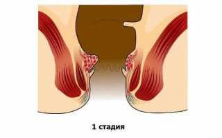 Начальная 1 стадия геморроя — лечение и профилактика