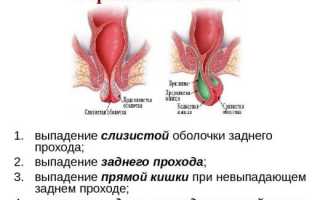 Что делать, если геморройная шишка вылезла наружу?