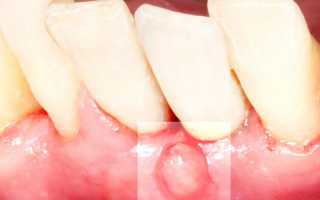 Почему возникает свищ после имплантации зубов, и что предпринять в такой ситуации