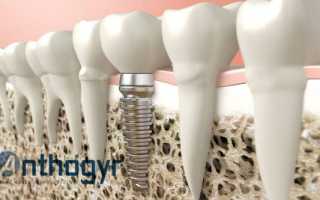Особенности восстановления утерянных зубов с помощью имплантов Антожир