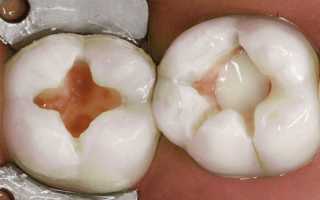 Когда и для чего нужны лечебные и изолирующие прокладки для зубов?