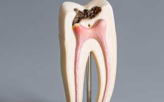 Обязательна ли депульпация зуба перед протезированием, как она проводится?