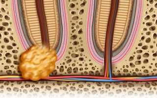 Все методы лечения гранулемы зуба