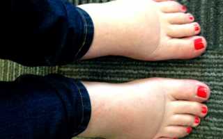Отёки ног после кесарева сечения: причины и лечение