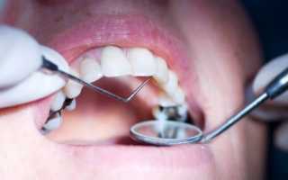 Аспекты проведения трепанации зуба и что это такое