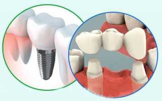 Чем отличается протезирование от имплантации зубов и что предпочтительней