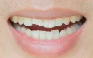 Можно ли и как восстановить зуб после перелома коронки