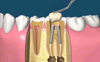 Нюансы использования анкерного штифта в стоматологии для восстановления разрушенного зуба