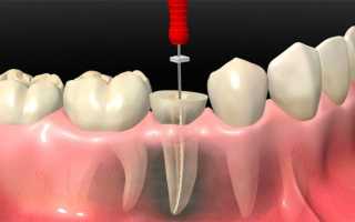 Форфенан для лечения и пломбирования корневых каналов в стоматологии