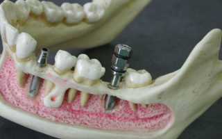Почему могут выпадать импланты зубов, и что предпринимается в таких случаях?