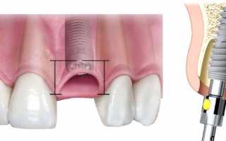 Установка импланта сразу после удаления зуба ― один из способов быстрого и надежного восстановления